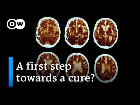 US drugmaker: Alzheimer’s development can be slowed down | DW News