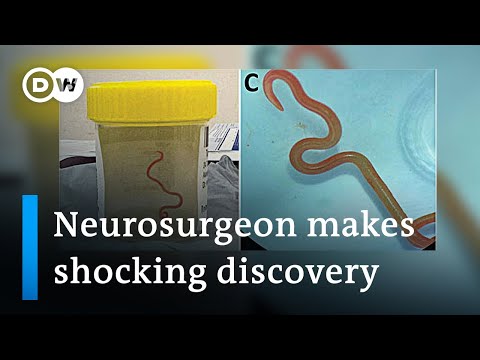 Neurosurgeon removes live worm from woman’s brain in world-first discovery | DW News