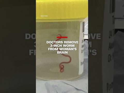 Worm removed from woman’s brain