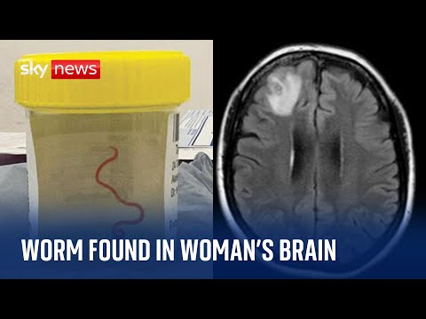 Live worm found in woman’s brain in world-first discovery