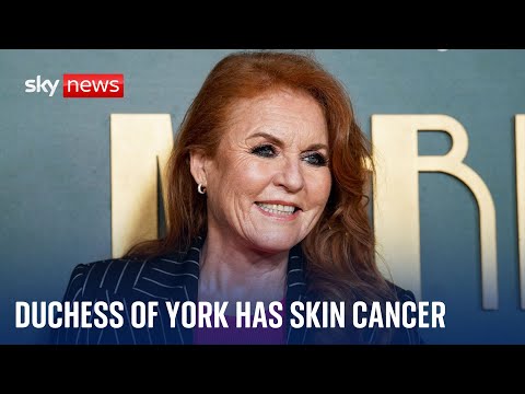 BREAKING: The Duchess of York Sarah Ferguson is receiving treatment for skin cancer