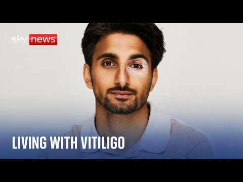 Two-thirds of those with skin condition vitiligo struggle with mental health