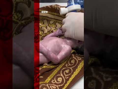 Baby saved from dead mother’s womb after Israeli strike. #Shorts #Gaza #BBCNews