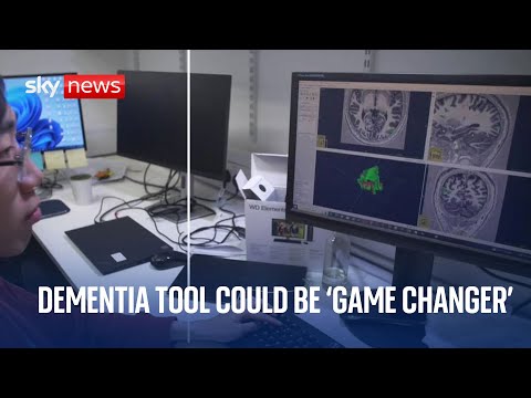 New AI tool hailed as a ‘game-changer’ for Alzheimer’s