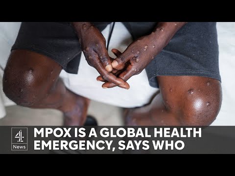Mpox: First case of contagious variant outside Africa reported