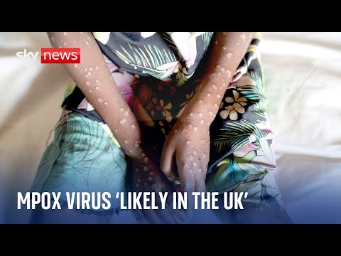 Experts warn deadly mpox virus is ‘quite likely’ in the UK