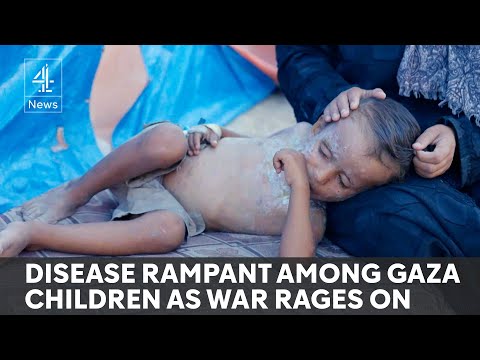 Malnutrition and terrible sanitation lead to epidemic of skin infections in Gaza