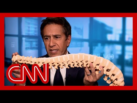 Sanjay Gupta gives demonstration on Mangione’s apparent spine condition