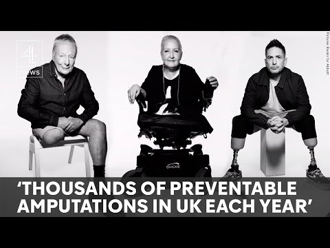 NHS could save millions from preventable amputations – new data