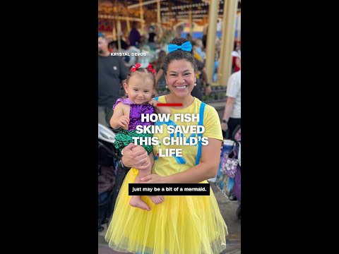How fish skin saved this child’s life