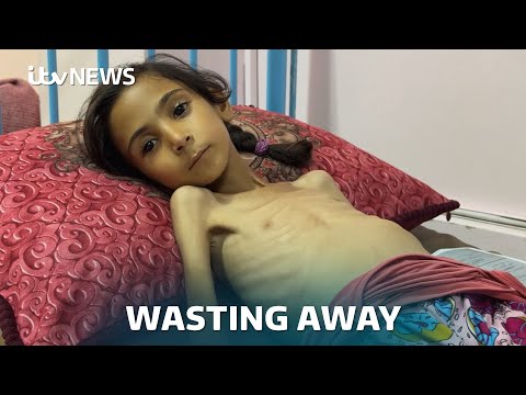 ‘I want to get treatment and look like I used to’: Malnourished Amal, 7, pleads for help in Gaza