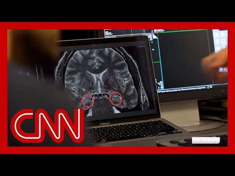 Hear why Alzheimer’s researchers are studying the brains of London cab drivers