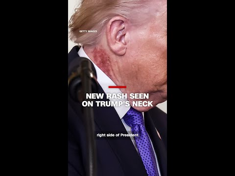 New rash seen on Trump’s neck