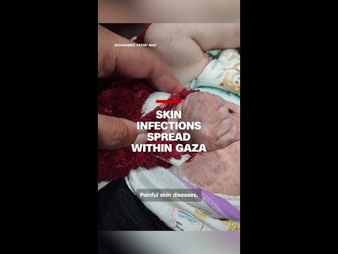 Skin infections spread within Gaza