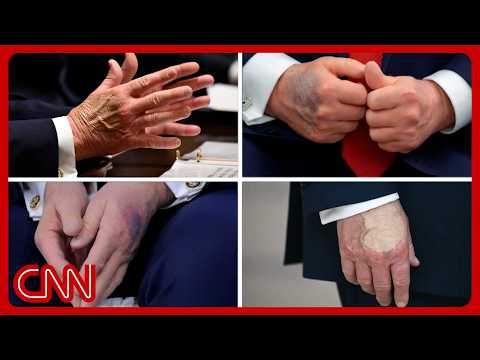 Trump’s physical exam: What doctors are watching for