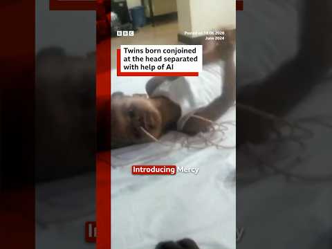 Twins born conjoined at the head separated with help of AI. #BBCNews