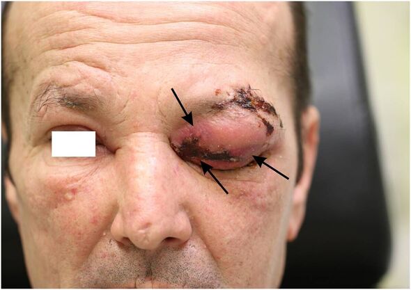 Flesh-eating eye bug outbreak leaves one man dead and two in hospital