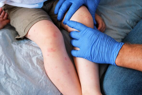 Highly contagious disease that was ‘eliminated’ in UK now ‘re-established’